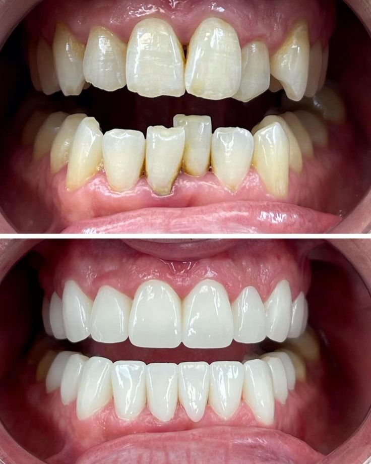 I pride myself in making the most natural straight teeth possible…that look fucking good! #instagood #transformation #makeover (1)